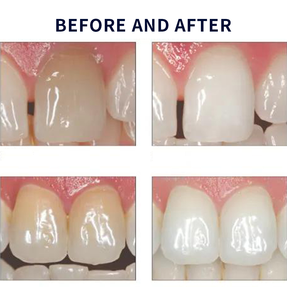 20% pF 20 16ชุดเจล8x1.2มล. ชุด - Teeth Whitening In Office บทวิจารณ์และราคา