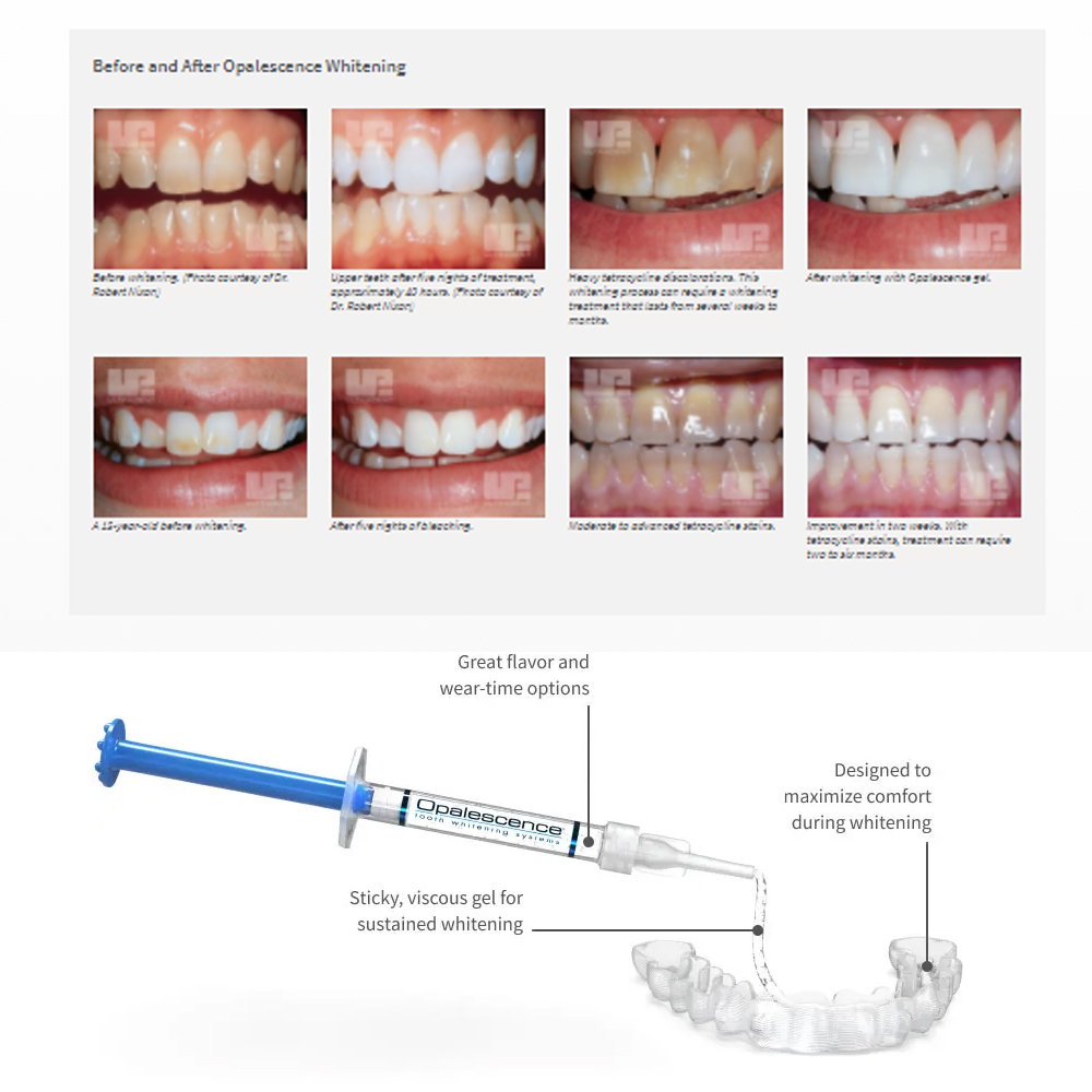 20% pF 20 16ชุดเจล8x1.2มล. ชุด - Teeth Whitening In Office บทวิจารณ์และราคา