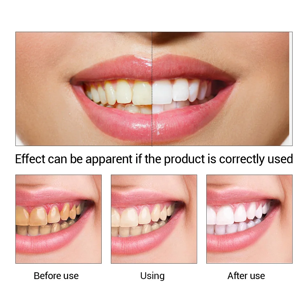 FTEENPLY ฟันไวท์เทนนิ่ง Oral ส - Teeth Whitening Remedies บทวิจารณ์และราคา