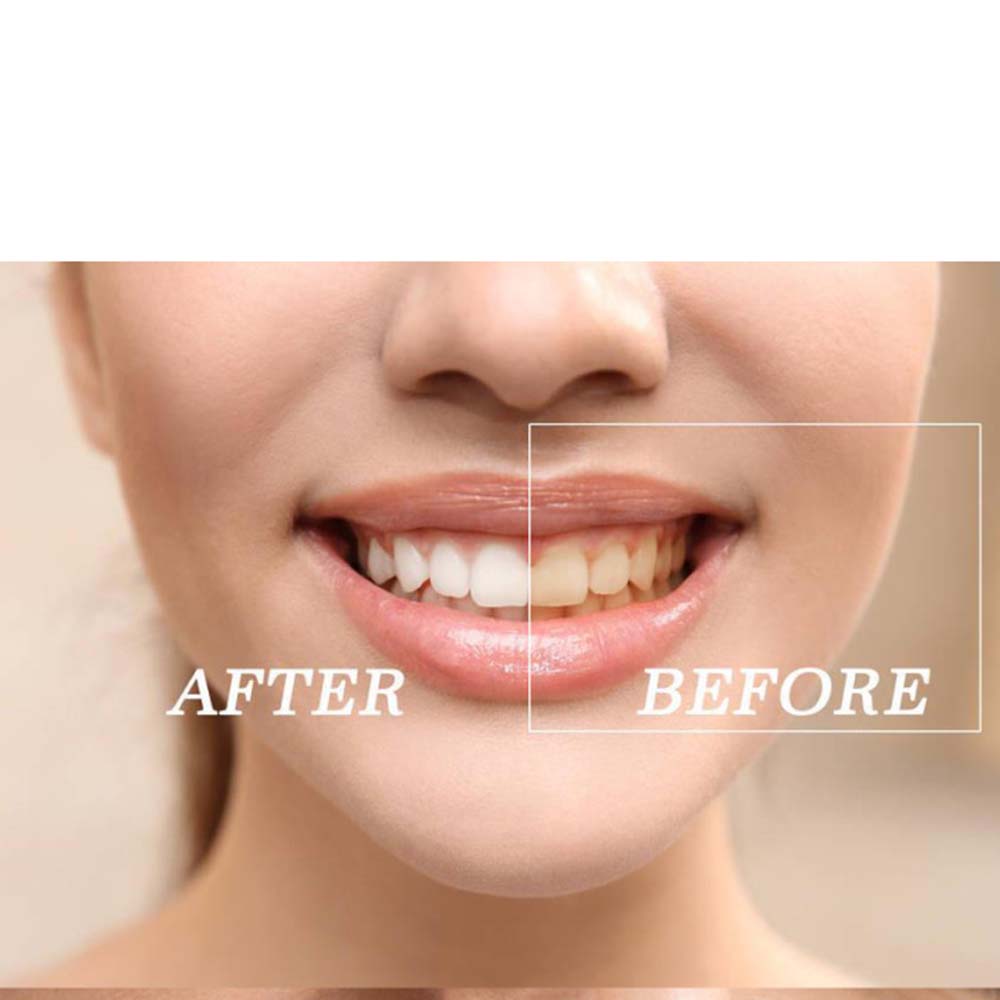 ชุดเจลฟอกสีฟอกสีฟันเปอร์ออกไซด - Teeth Whitening Bleach บทวิจารณ์และราคา