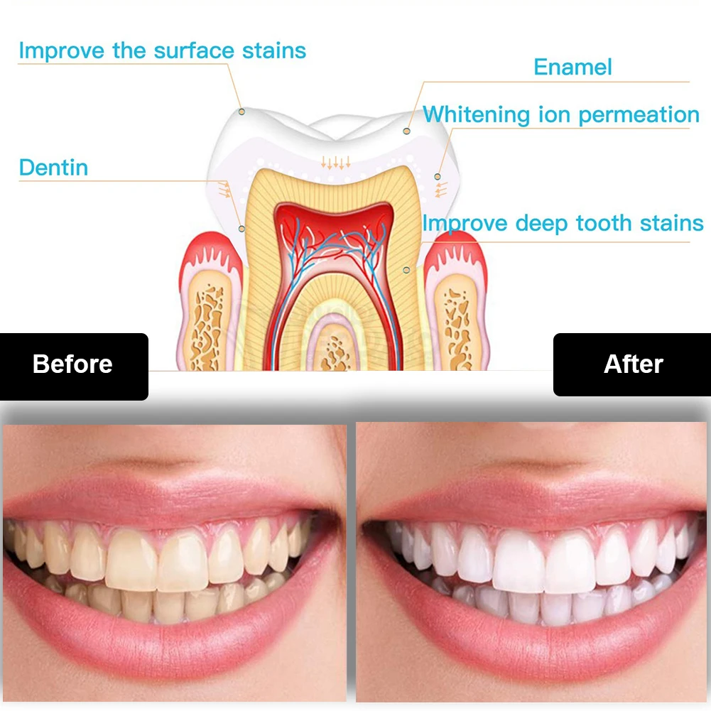 ทันตกรรมชุดฟอกสีฟัน Mini 16 LE - Teeth Whitening Pen บทวิจารณ์และราคา