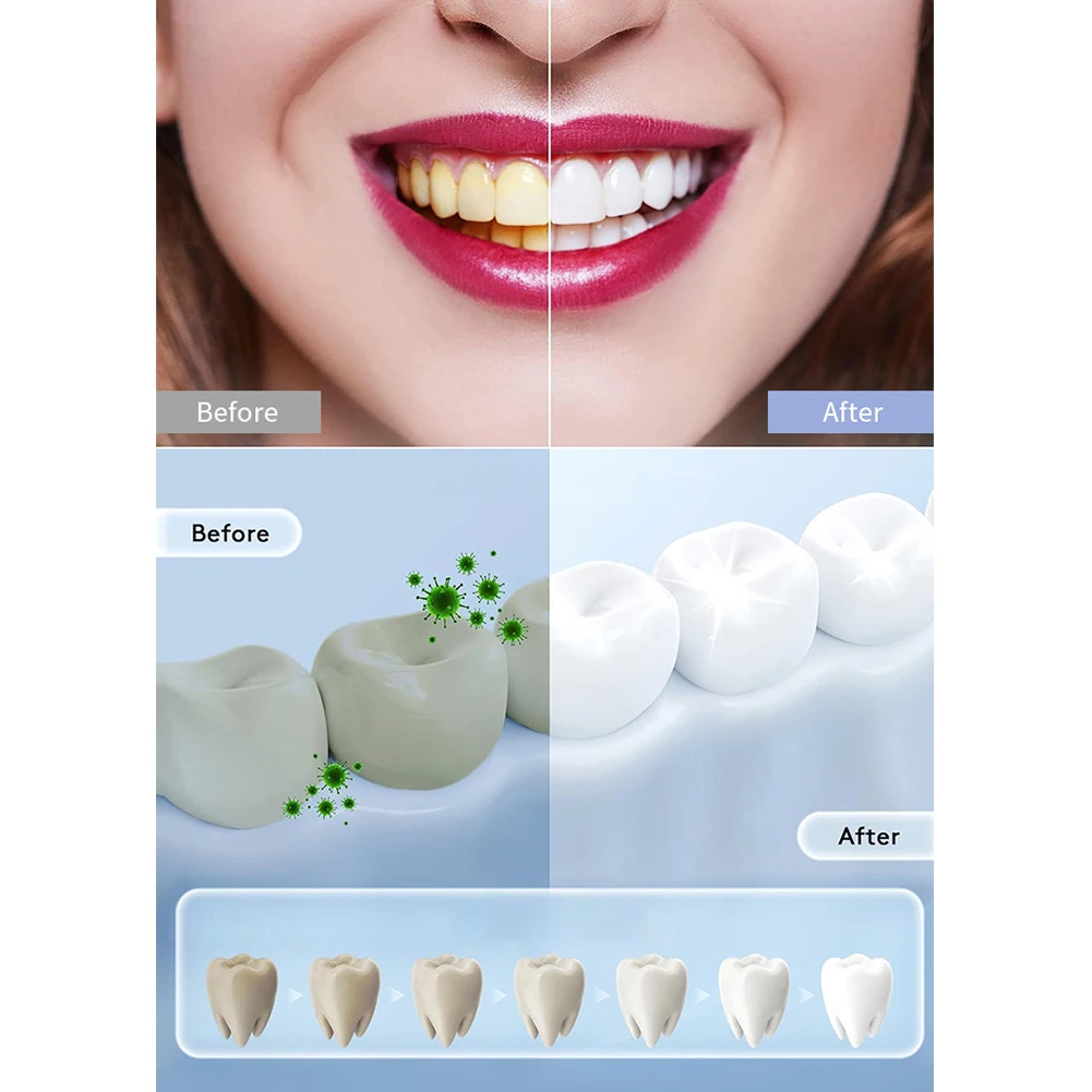 หลอดไฟฟอกฟัน LED อัจฉริยะสำหรั - Teeth Whitening In Office บทวิจารณ์และราคา